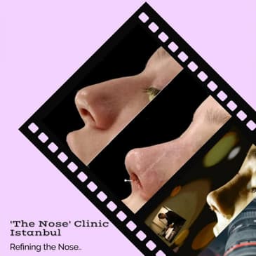 Slider image (3) The Nose Aesthetic Clinic